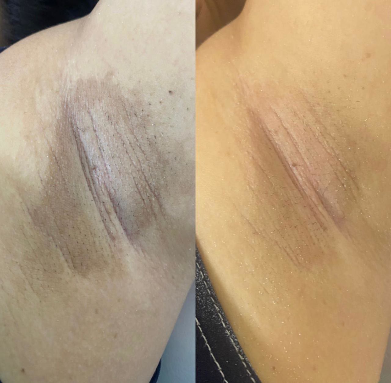 Antes e depois do clareamento da axila
