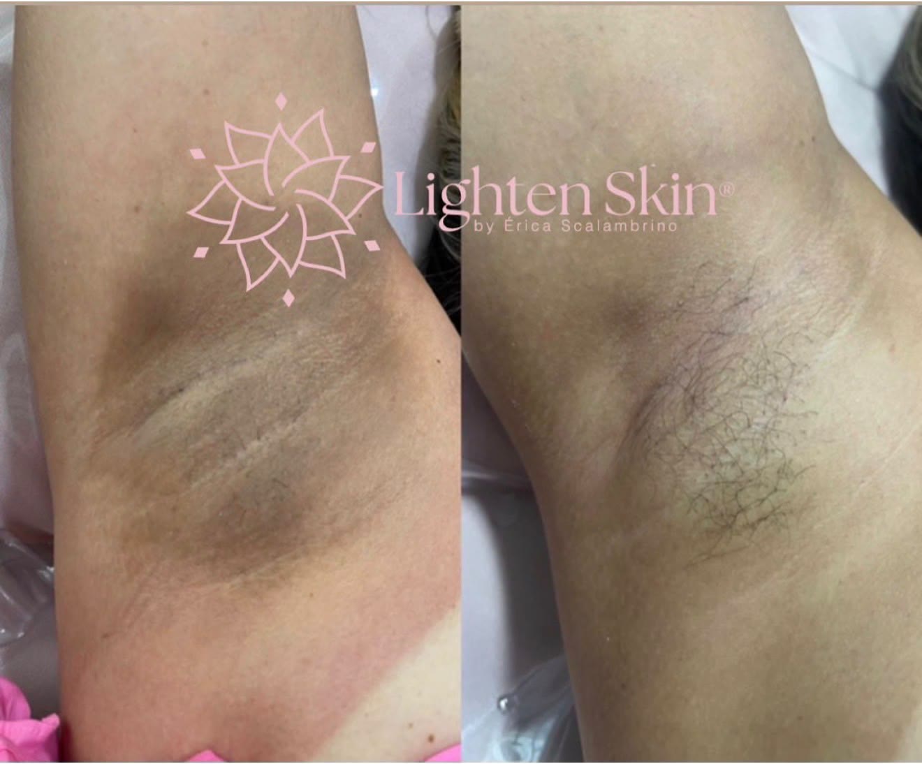Antes e depois do clareamento das axilas