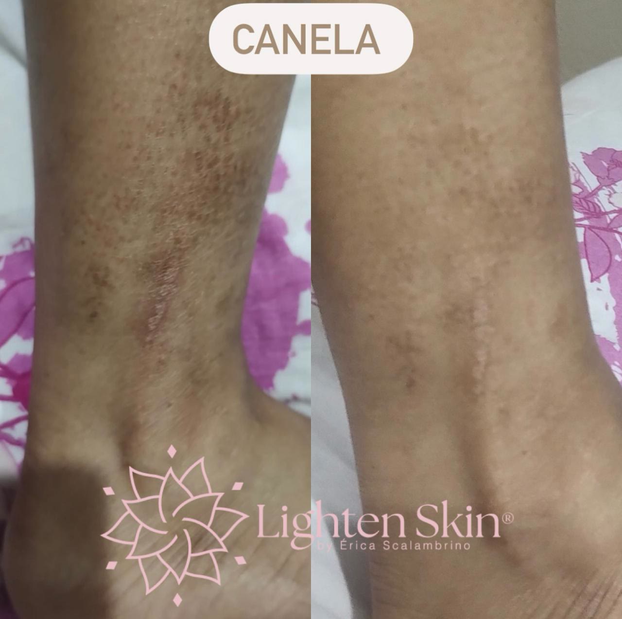 Antes e depois do tratamento na canela