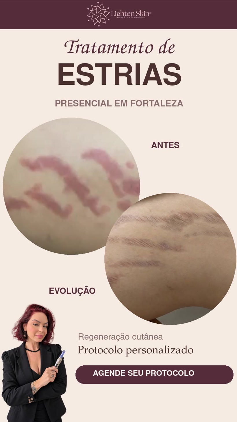 Protocolo de tratamento de estrias, antes e evolução
